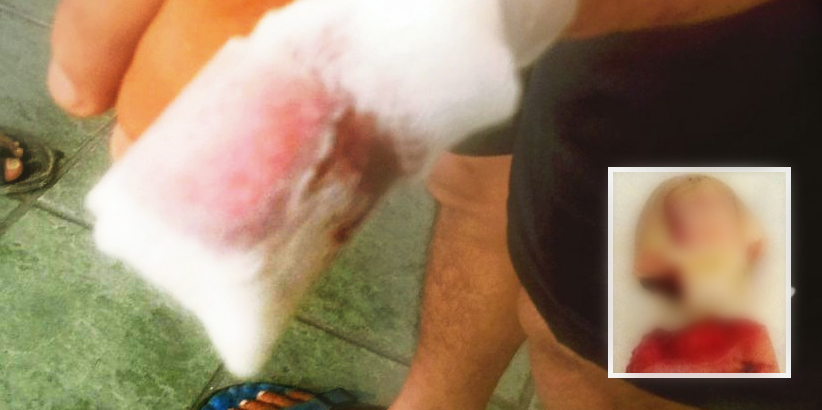 Crazy Woman Was So Angry She Bit Off Husband's Finger, And The Reason Is Extremely Ridiculous - World Of Buzz 3