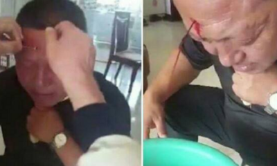 'Doctor' Punctures Hole In Man's Forehead As Treatment For Headaches - World Of Buzz 5