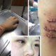 Malaysian Girl Shares Terrifying Moment Ruthless Snatch Thieves Slashed Her Arm - World Of Buzz