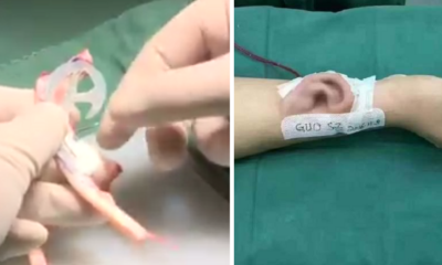 Guy Loses Right Ear in Accident, Doctors Grow Another on his Arm! - World Of Buzz 5