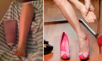 Woman Had To Amputate Her Lower Leg After Getting A Blister from Wearing Heels - World Of Buzz 3