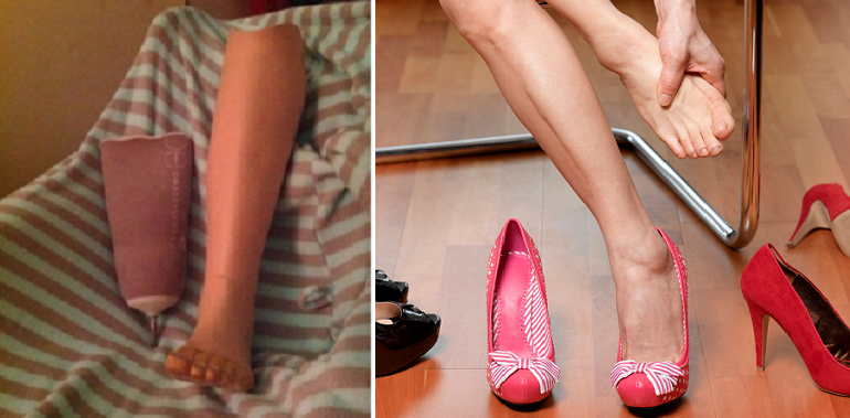 Woman Had To Amputate Her Lower Leg After Getting A Blister from Wearing Heels - World Of Buzz 3