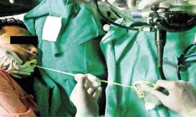 1.88m Long Tapeworm Pulled Out From Guy's Stomach - World Of Buzz