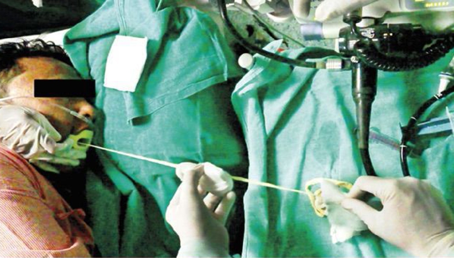 1.88m Long Tapeworm Pulled Out From Guy's Stomach - World Of Buzz