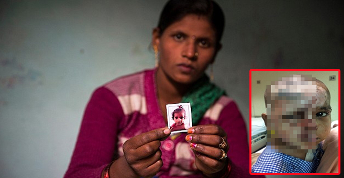 Innocent 2 YO Boy's Face Splashed With Acid, After His Mother Rejects A Man's Love - World Of Buzz