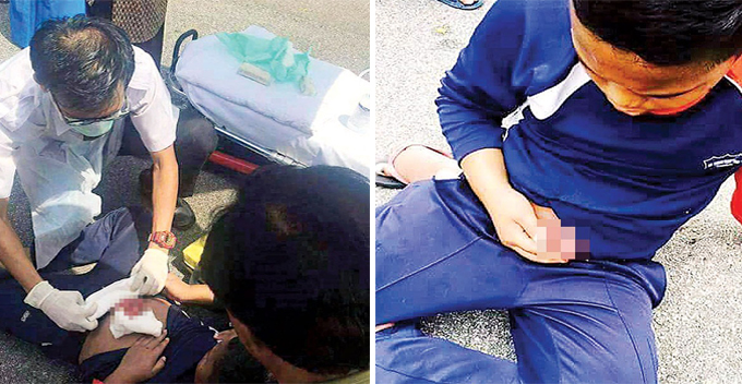 Malaysian Boy's Small Intestines Exposed After Stomach Penetrated By Bicycle Handle - World Of Buzz 2