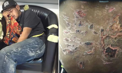 Malaysian Man Caned And Burnt By Exhaust Pipe For Not Meeting Sales Target - World Of Buzz