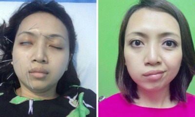 Malaysian Woman Shares The Surprising Story Of Why Her Face Was Drooping On Side - World Of Buzz 11