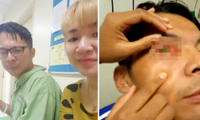 Malaysian Man Suffers Severe Cornea Damage After Sleeping With Contacts In - World Of Buzz 2