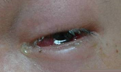 Severe eye infection caused 3 Taiwanese to nearly lose their eyesight - World Of Buzz 1
