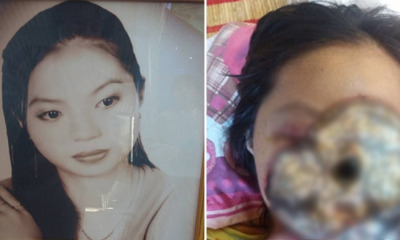 Vietnamese Girl's Face 'Eaten' By Bacteria Due To Sinus Infection - World Of Buzz