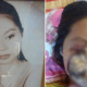 Vietnamese Girl's Face 'Eaten' By Bacteria Due To Sinus Infection - World Of Buzz