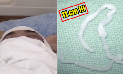 Chinese Man Cuts His Finger, Parasite Travels Through the Wound To Brain - World Of Buzz