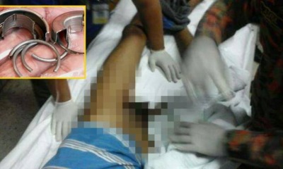 Malaysian Man Suffered 12 Hours Of Pain After Penis Ring Could Not Come Off - World Of Buzz 4