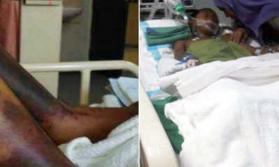 Primary School Student May Lose Right Arm, Johor Permaisuri Urges Prompt Action - World Of Buzz 2