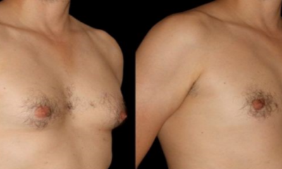 Singaporean Man Gets Breast Reduction Surgery After Failing to Reduce Fat - World Of Buzz 5