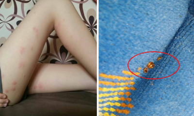 Girl Experiences Terrible Bed Bug Bites in Express Bus from Thailand to KL - World Of Buzz 3