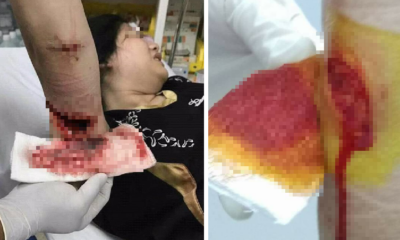 Siblings Suffer Horrible Injuries while Having Family Day Out at Melaka Resort - World Of Buzz 4