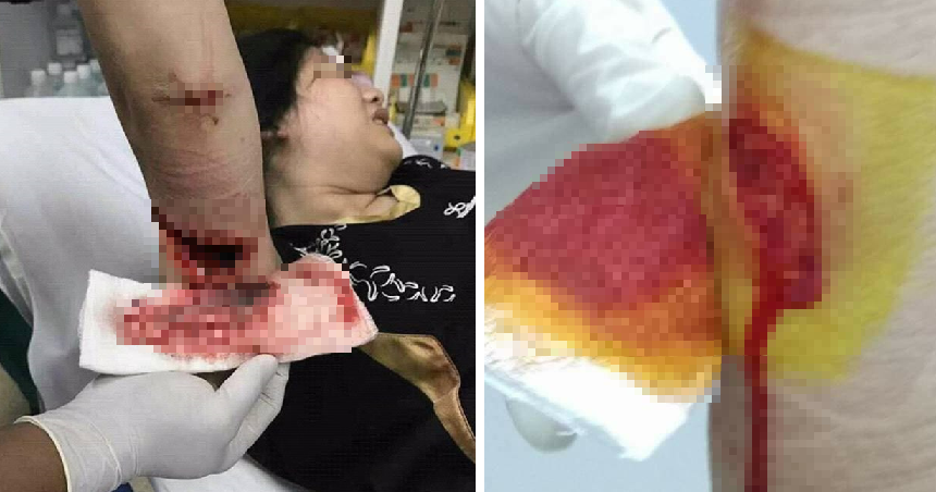 Siblings Suffer Horrible Injuries while Having Family Day Out at Melaka Resort - World Of Buzz 4