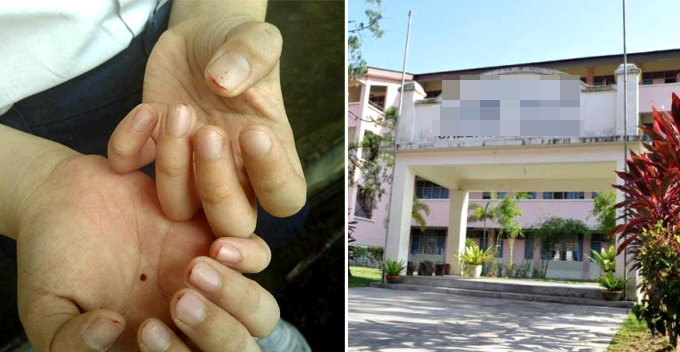 Standard 2 Pupil's Fingers Bleed After Finger Nails Clipped by Impatient Teacher As Punishment - World Of Buzz