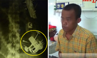 Doctors Found 52 Foreign Objects in Indonesian Man's Stomach, 18 were lighters - World Of Buzz