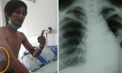 Indonesian Man Suffers Collapsed Lung Due to Smoking, Netizens Vow to Quit - World Of Buzz