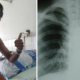 Indonesian Man Suffers Collapsed Lung Due to Smoking, Netizens Vow to Quit - World Of Buzz