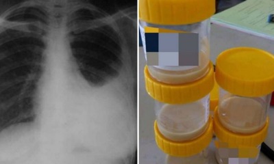 24yo Malaysian Smoker Dies After Doctor Finds Nearly 1 Litre of Pus in Lung - World Of Buzz