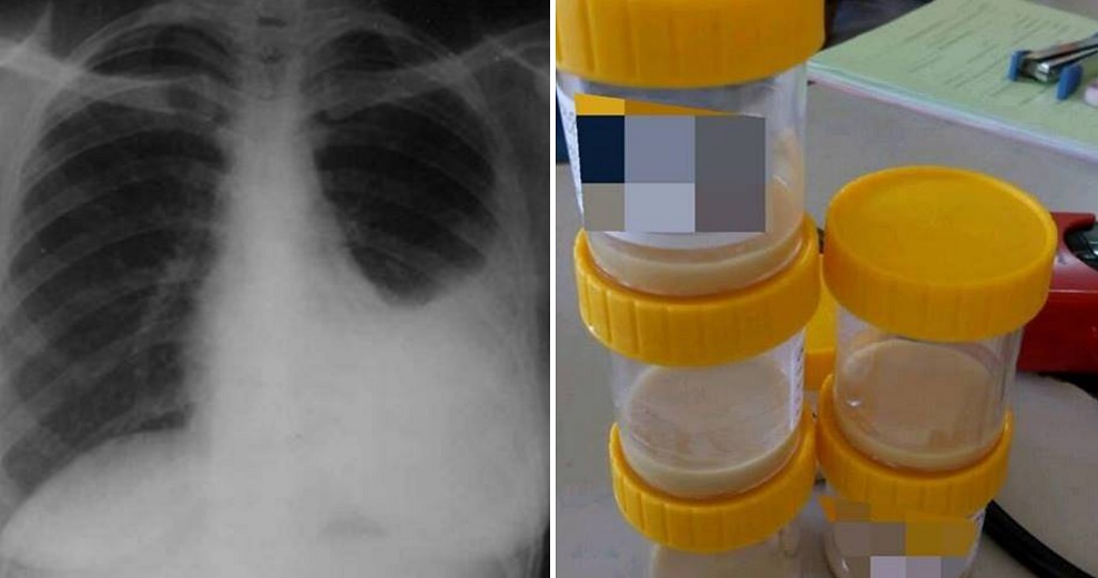 24yo Malaysian Smoker Dies After Doctor Finds Nearly 1 Litre of Pus in Lung - World Of Buzz
