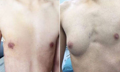 Doctors Suspect Male Teen's A Cup Right Breast Caused by Excessive Fast Food - World Of Buzz 4