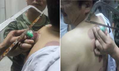 Firefighters Saw Off Cup Stuck to Man's Back Due to Home Cupping Therapy - World Of Buzz 3