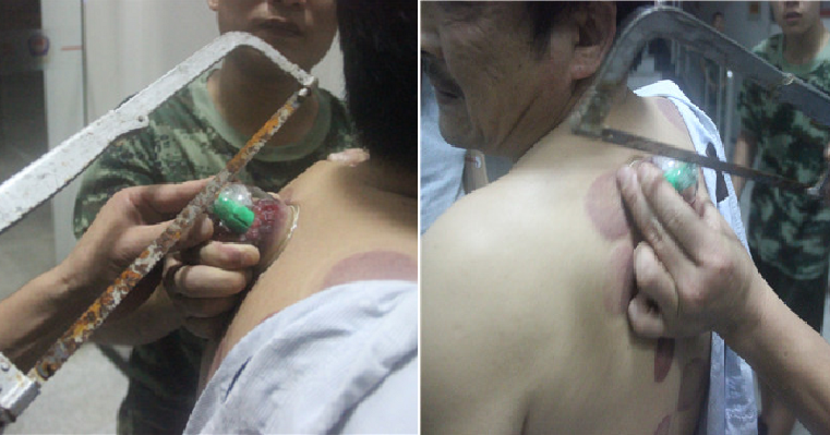 Firefighters Saw Off Cup Stuck to Man's Back Due to Home Cupping Therapy - World Of Buzz 3