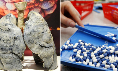 Man's Lungs Turn Into Cotton-Like After Excessive Consumption of Antibiotics - World Of Buzz