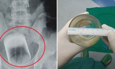 Doctors Find Glass Stuck in Man's Rectum, He Refuses to Explain How it Happened - World Of Buzz 3