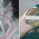 Doctors Find Glass Stuck in Man's Rectum, He Refuses to Explain How it Happened - World Of Buzz 3