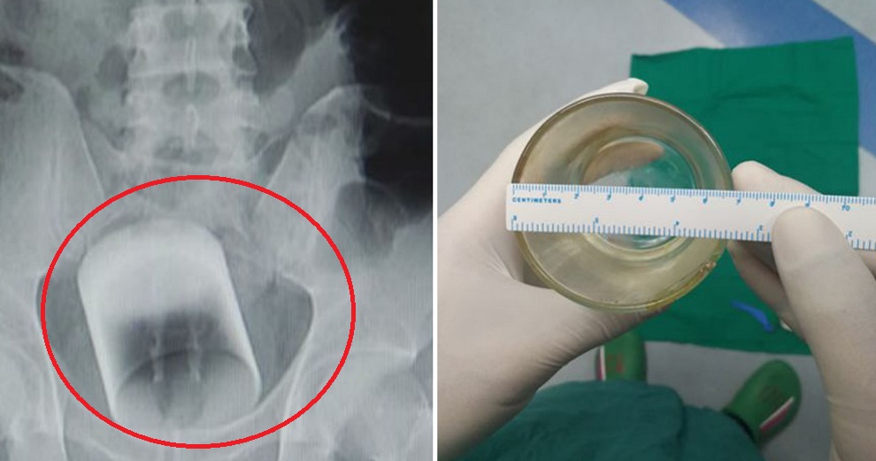 Doctors Find Glass Stuck in Man's Rectum, He Refuses to Explain How it Happened - World Of Buzz 3