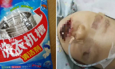 Toddler Sustains Serious Injuries on Mouth and Body After Accidentally Eating Washing Powder - World Of Buzz 2