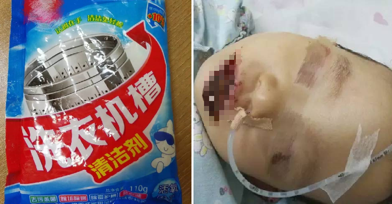 Toddler Sustains Serious Injuries on Mouth and Body After Accidentally Eating Washing Powder - World Of Buzz 2