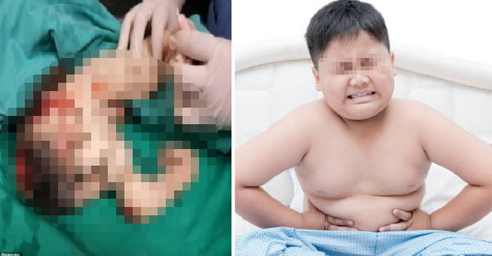 M'sian Doctors Removed Young Boy's Unborn Twin in His Body After 15 Years - WORLD OF BUZZ 1