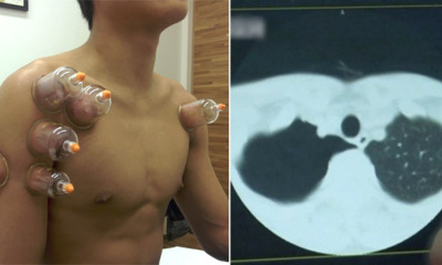 Man With Bronchitis Undergoes Cupping Therapy, Lungs Shockingly Shrunk For 90% - WORLD OF BUZZ