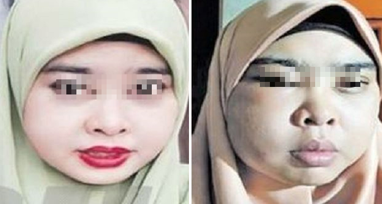 M'sian Woman Suffers From Swollen, Painful Face After Using Online Beauty Product - WORLD OF BUZZ 4