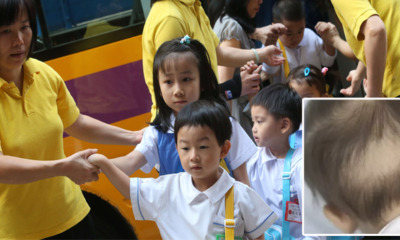 Toddler Loses Hair After Attending Five Classes to Qualify for Kindergarten Entrance Test - WORLD OF BUZZ