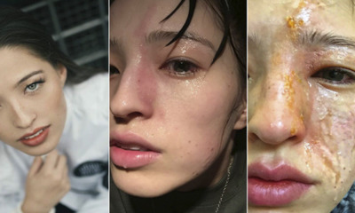Young Lady Disfigured After Essential Oil Vapour Accidentally Sprayed on Her Face - WORLD OF BUZZ