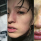 Young Lady Disfigured After Essential Oil Vapour Accidentally Sprayed on Her Face - WORLD OF BUZZ