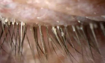 Woman Uses Unwashed Pillow Case for 5 Years, Contracts Over 100 Mites in Her Eyelashes - WORLD OF BUZZ