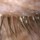 Woman Uses Unwashed Pillow Case for 5 Years, Contracts Over 100 Mites in Her Eyelashes - WORLD OF BUZZ