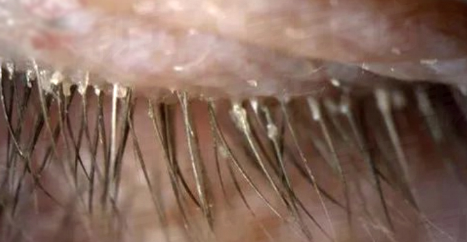 Woman Uses Unwashed Pillow Case for 5 Years, Contracts Over 100 Mites in Her Eyelashes - WORLD OF BUZZ