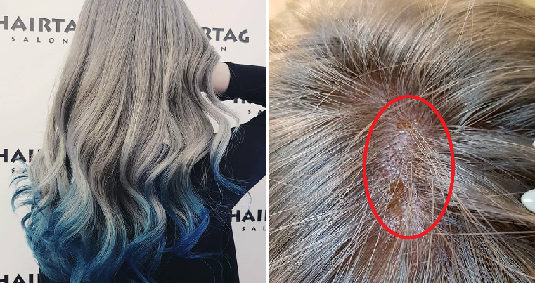 Girl Suffers Chemical Burns on Scalp After Salon Leaves Bleach on for 3 Hours - WORLD OF BUZZ 6