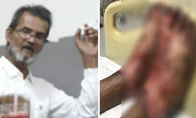Man Suffers Terrible Burn After Getting Conned by Bogus Private Doctor in Sg. Buloh - WORLD OF BUZZ