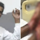 Man Suffers Terrible Burn After Getting Conned by Bogus Private Doctor in Sg. Buloh - WORLD OF BUZZ